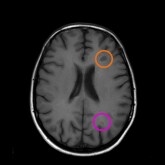 MRI showing T1-weighted scans with gadolinium