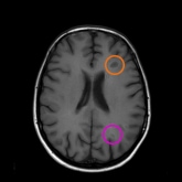 T1-weighted MRI scans with gadolinium highlight only active lesions. An orange circle points out Black hole while a purple circle points out Gd T1-w lesions.
