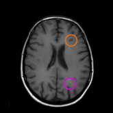 T1-weighted MRI scans with gadolinium highlight only active lesions. An orange circle points out Black hole while a purple circle points out Gd T1-w lesions.