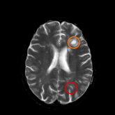 T2-weighted MRI scans shows all lesions in the central nervous system. An orange circle points out Black hole while a red circle points out T2-w lesions.